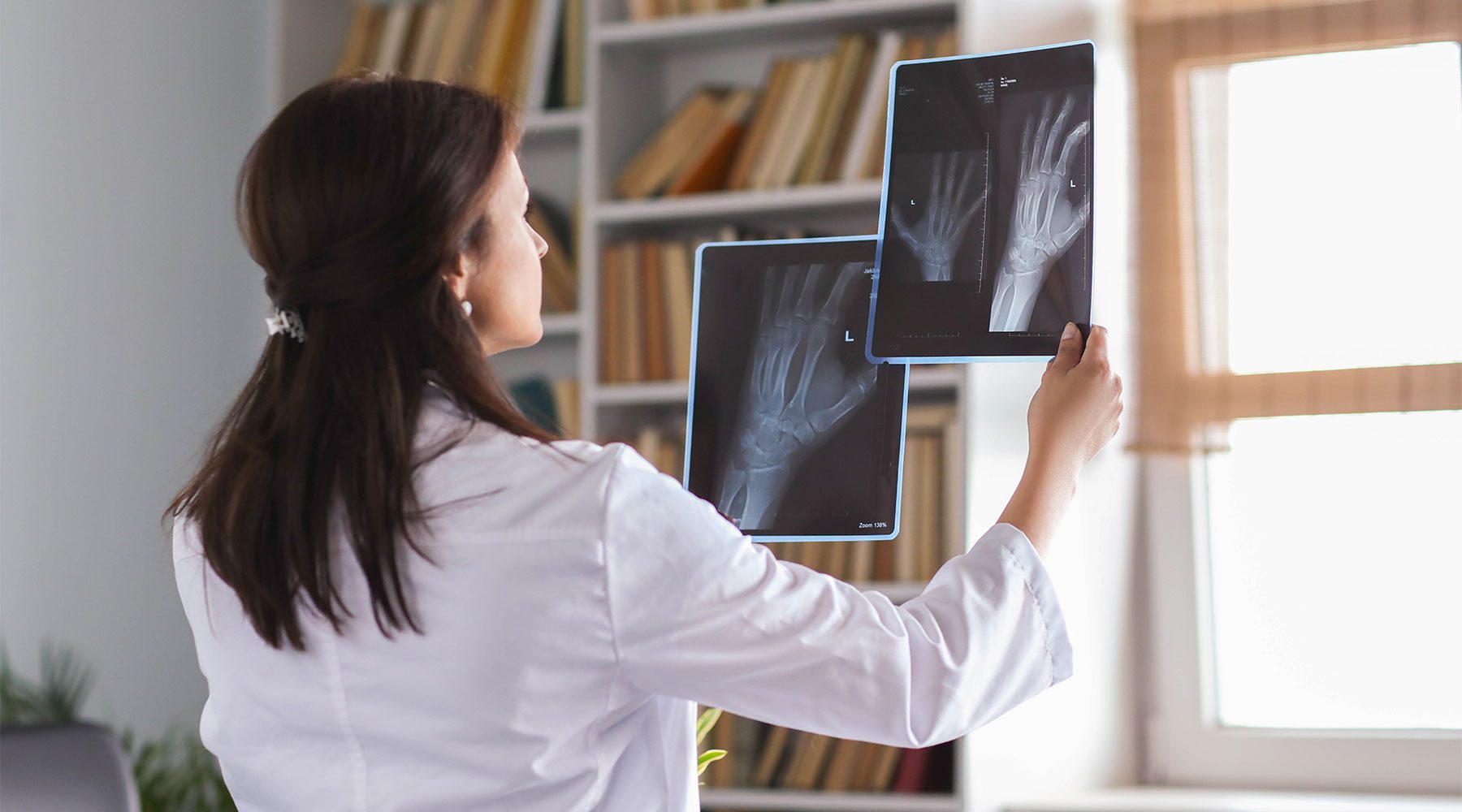 Doctora analizando dos radiografías para comprobar posible artrosis en manos.