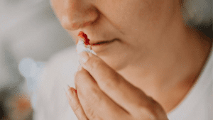 Hemorragias nasales en adultos mayores