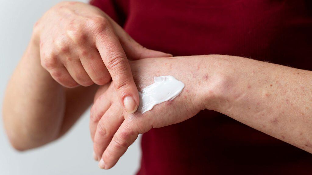 El envejecimiento es una de las causas de las manchas de sangre en la piel de los ancianos.