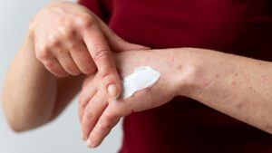 El envejecimiento es una de las causas de las manchas de sangre en la piel de los ancianos.