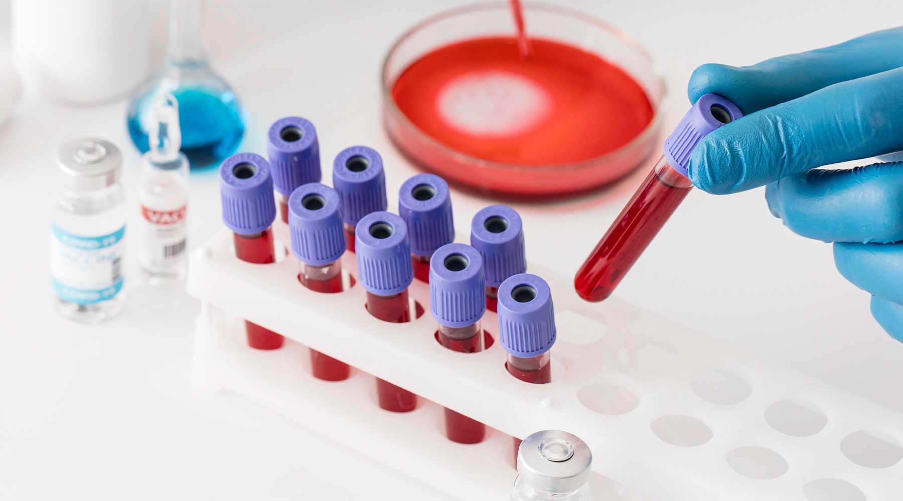 Análisis de sangre en laboratorio para la comprobación de colesterol en sangre.