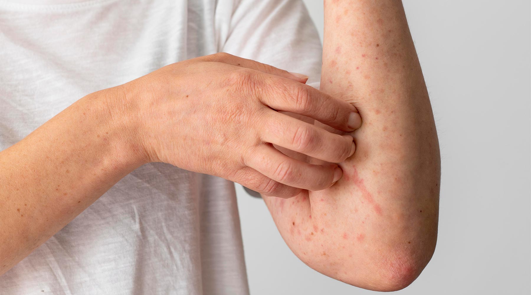 Reacción alérgica cutánea en el brazo de una persona mayor.
